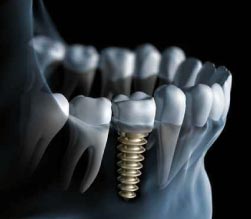 prothèse dentaire sur implant